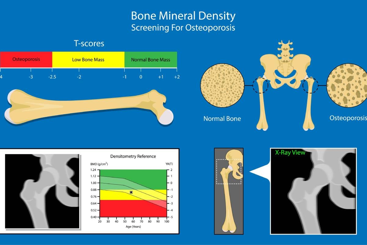 T Score Chart For Bone Density Unified Premier Women s Care